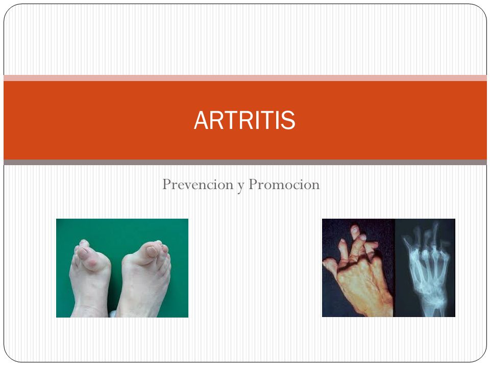 Artritis prevención